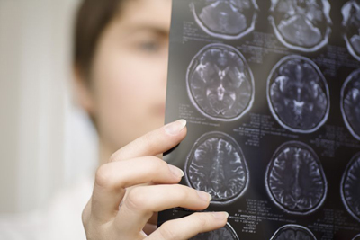 Una nueva tcnica revela bajo nivel de hierro cerebral en pacientes con TDAH